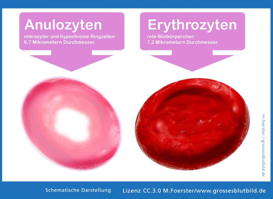 Anulozyten im Blutbild » Fotokunstweb.de
