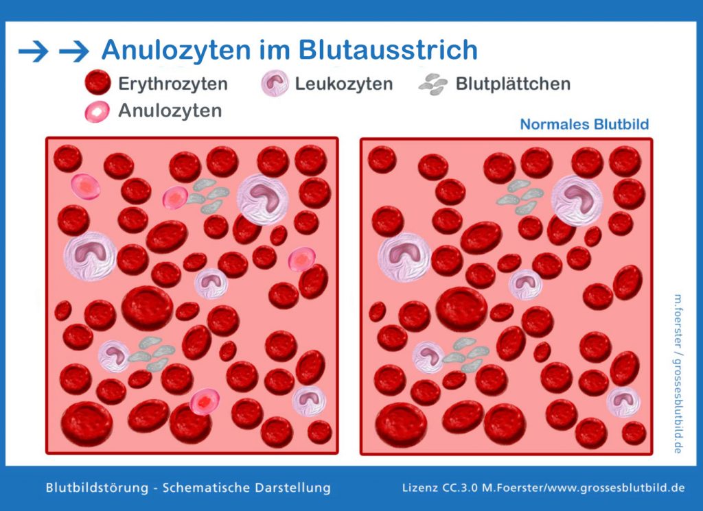 Anulozyten im Blutbild » Fotokunstweb.de