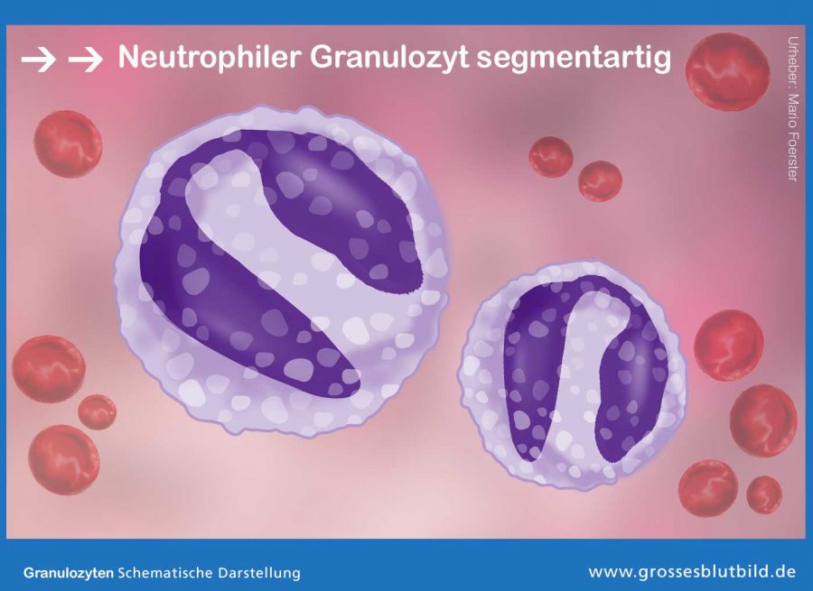 Neutrophiler-Granulozyt-segmentartig