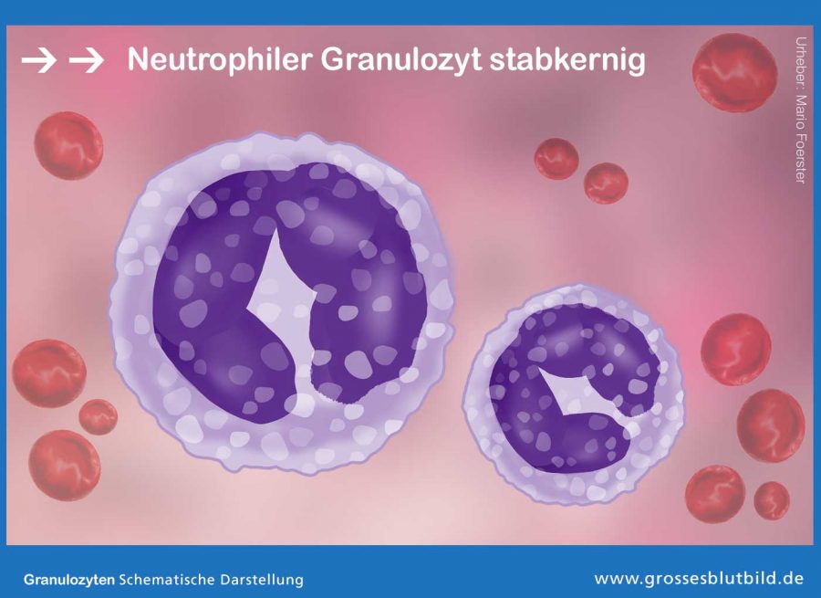 Neutrophiler-Granulozyt-stabkernig